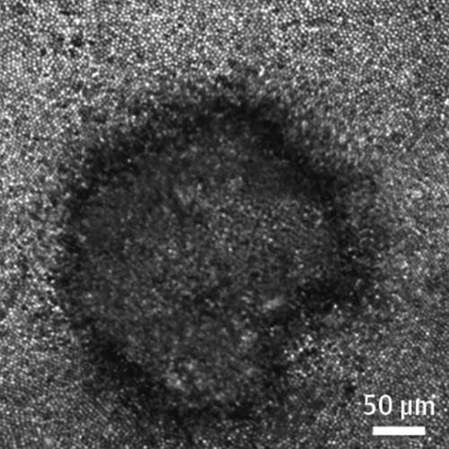 This microscope image provided by Mount Sinai’s New York Eye and Ear Infirmary shows damage to the retina of a person who viewed the 2017 eclipse without adequate protection. She complained of a black spot in her vision, and doctors discovered retinal damage that corresponded to the eclipse’s shape. (New York Eye and Ear Infirmary of Mount Sinai, JAMA via AP)